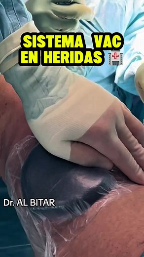 Sistema VAC en Heridas: Acelera la Cicatrización
