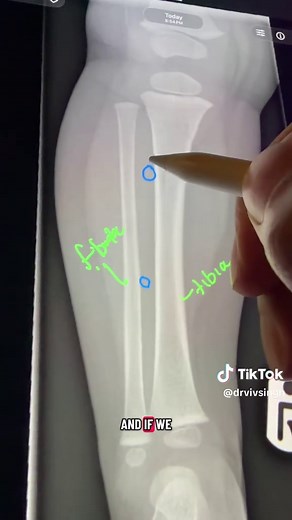Buckle Fracture in Children: Signs, Diagnosis, and Treatment