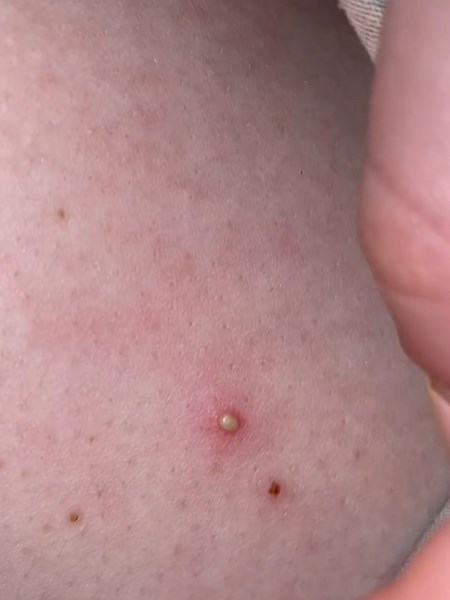 How to Treat a Small Pimple on My Leg