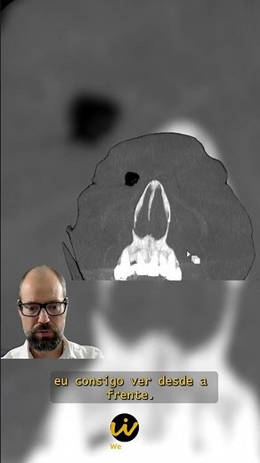 Facial Fracture - Tip for detecting Le Fort type I on Facial CT Scan