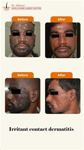 Skin Redness & Irritation? Simple Solution Explained | Irritant Dermatitis Tamil