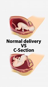 160K views · 1.7K reactions | Which one would you prefer? Follow us for more pregnancy and parenting videos. (pregnancy, pregnant, c section, baby delivery, birth, mom) | Pregnancy Guide | Facebook