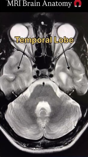 Learn MRI Brain Anatomy 🧠 #ytshorts #science #anatomylearning #viralshot #medicos