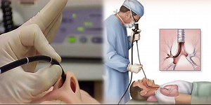 Bronhoskopija – kako i kada se radi, priprema, oporavak