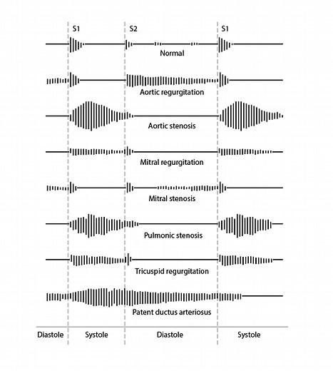 Aortic Regurgitation - Cardiology - Merck Manual Professional Edition