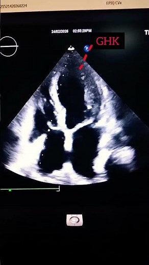 "CKD Alert! Heart failing, globally ailing RWMA +, Severe MR, Low EF"