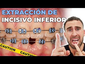 LOWER INCISOR EXTRACTION in ORTHODONTICS | Were you told you need one? Let me explain WHY ☝🏼️