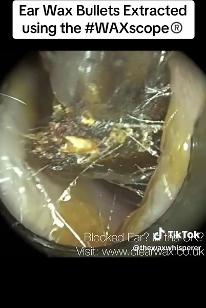 Ear Wax Bullets Extracted using the #WAXscope®️ #ear #earwax #earwaxremoval #earwaxremover #earwaxremovalspecialists #earwaxcleaning