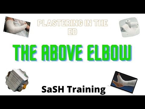 Plastering in the ED - The Above Elbow POP Backslab