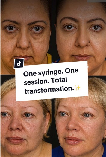 Watch this before & after and see what a difference a tear trough filler can make 👀✨ From tired to refreshed in under 30 minutes, this treatment smooths out hollowness under the eyes, reduces dark circles, and instantly lifts your overall appearance—no surgery, no filter needed. The best part? You still look like you, just well-rested and glowing. Results are instant and long-lasting. This is the definition of a high-impact, low-effort beauty tweak. #EyeFillerTransformation #GlowUpTikTok #Derma