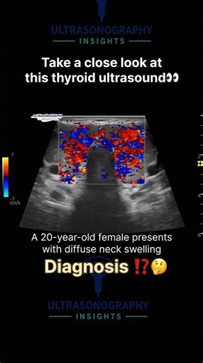 Can You Diagnose This Diffusely Hypervascular Thyroid? 🤔#Radiology #GravesDisease #reels