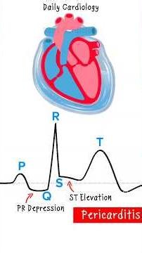 ECG changes in Cardiac abnormalities (Pericarditis, HCM, ARVC, DCM, STEMI) #ecg #cardiology