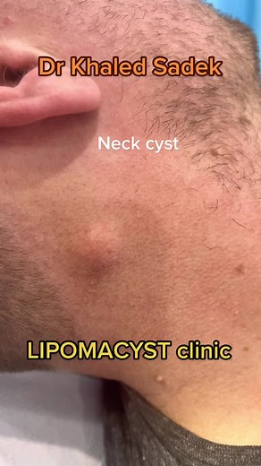 Cyst removal from dr Khaled sadek performed at our state of the art clinic in London LIPOMACYST clinic