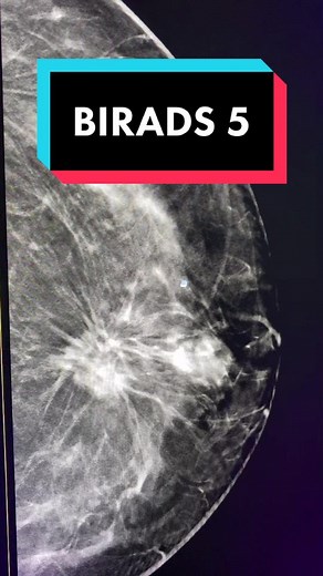 BIRADS 5 #mamografia #tomosintesis #rayosudem #radiologia
