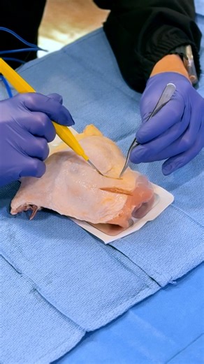 Dr. David Feldmar on Instagram: "Meet the Bovie—aka the electric knife.⚡ It cuts, it coagulates, it keeps surgery safe. In this demo, I’m using a chicken breast, to show how this essential tool allows us to precisely cut tissue while minimizing bleeding. A total game changer that’s made modern surgery safer and more efficient for both surgeons and patients. 📞 Connect with us! 📩 Send us a DM 📱 Call 424-722-3769 🌍 Visit FeldmarAesthetics.com"