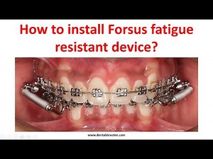 How to install Forsus Fatigue resistant Appliance - Functional Class II corrector
