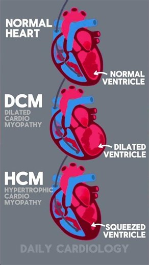 Normal Heart vs Dilated Cardiomyopathy vs Hypertrophic Cardiomyopathy #cardiology #shorts #heart