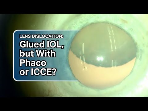 Lens Dislocation: Glued IOL, but With Phaco or ICCE?