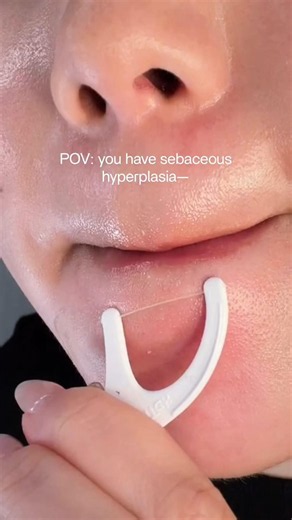 Dental floss hack to clear out stubborn pores.