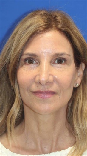 UNDETECTABLE Facelift at 65 - Before & After Her Vertical Restore