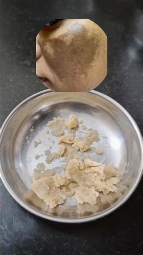भर-भर के #pigmentationremedy #melasma #pigmentation #झाइयां