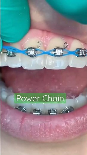 How Power Chain put on the Braces bracket|Orthodontic Treatment|How powerchain work|Ortho Dentistry