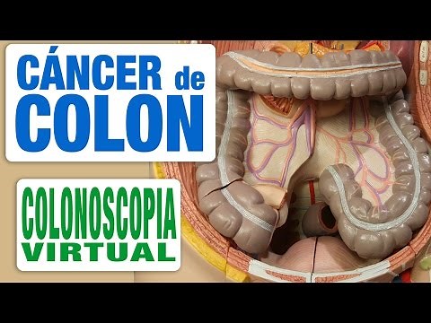 Virtual Colonoscopy - How Is It Done?