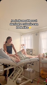 Ongoing inflammation in your bowels is not fun 😬. It doesn’t just stay in one spot—it can spread and lead to more serious conditions like IBS, autoimmune disorders, or even chronic pain. 💥 When your body is constantly inflamed, it’s working overtime, leaving you feeling sluggish, bloated, and off balance. Your gut health is EVERYTHING for your overall well-being! 💚 That’s where colonics come in! 💧 Colonics help to gently flush out toxins, waste, and excess inflammation that may be lingering 