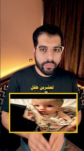متلازمة موبيوس، المرض اللي بيمنع الأطفال من الابتسام طول عمرهم | الساينتست - El Scientist