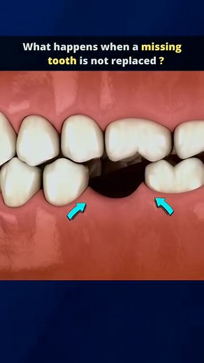 117K views · 826 reactions | Consequences of not replacing a missing tooth! 醴 * A missing tooth can lead to potential problems if not treated. Drifting and shifting of the neighboring teeth causing an unbalanced bite. Increased biting stress on other teeth. Bone recession in the area of the missing tooth. The gap between teeth widens, thereby compromising the esthetic effect. Losing your natural smile. | Dental Daily | Facebook