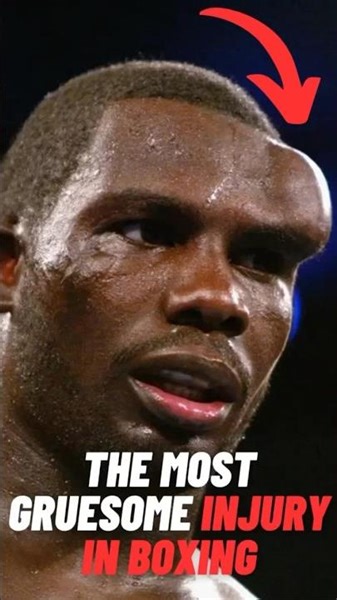 The Most Gruesome Injury In Boxing