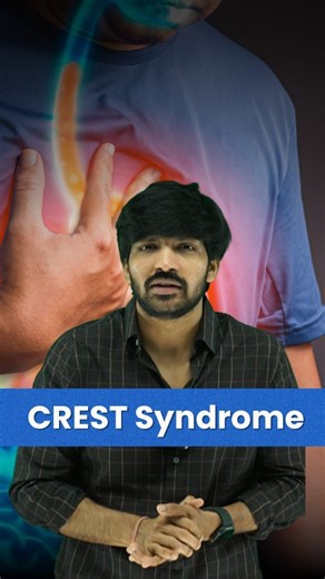 The CREST Syndrome Connection! 💡 Ever encountered a patient with seemingly unrelated symptoms like persistent acid reflux AND skin thickening on their hands? 🤔 This clinical presentation is a vital clue that points towards a specific diagnosis. These symptoms, especially together, should immediately make us consider CREST Syndrome, a limited form of Systemic Sclerosis. It's an acronym worth remembering: Calcinosis: Small, firm calcium deposits under the skin. Raynaud's Phenomenon: Spasms in bl