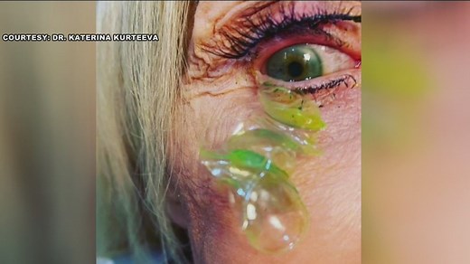 VIDEO: California doctor removes 23 contact lenses from woman's eye