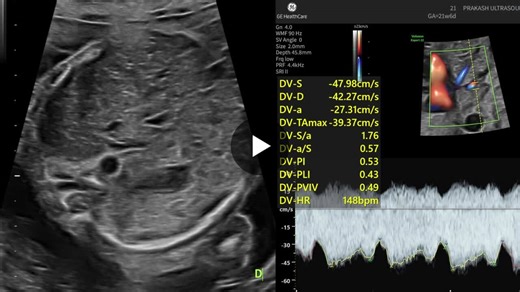 #fetalecho #mesocardia #prenataldiagnosis #ultrasoundteaching | Dinesh Prakash Singh