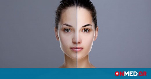 Πανάδες: Γιατί εμφανίζονται και πώς θα τις αντιμετωπίσετε (pics&vid)