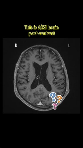 MRI Brain Scan: Identifying Key Lesions