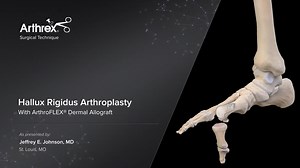 Hallux Rigidus Arthroplasty With ArthroFLEX® Dermal Allograft