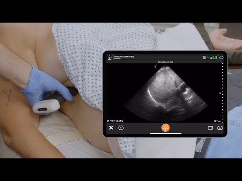 Pre Block Scanning and Cervical Plexus Block