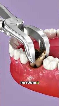Removing a bad tooth | Tooth extraction procedure 3d animation #ToothExtraction #DentalSurgery #Med