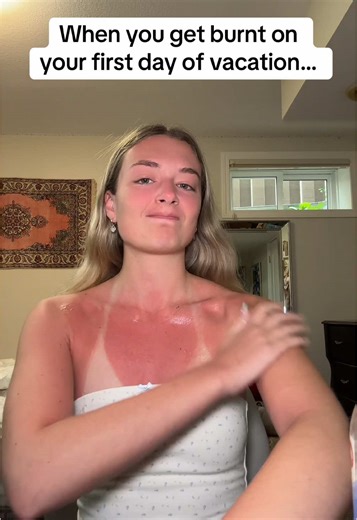 Managing Sunburn on Your Vacation