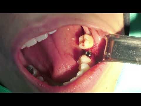 Tissue level Implant & roll technique| surgery| dentistry| oral surgeon