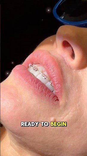 Getting Braces: Here’s How It Works 👆