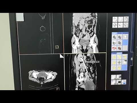 Tomografia uro TC