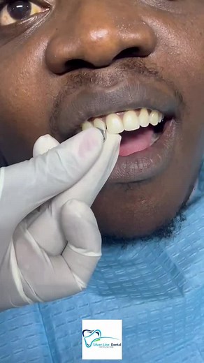 Permanent Silver Teeth: Transforming Smiles with Full Silver Teeth