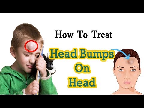 How to Get Rid of Head Bump Naturally at Home || Home Remedies for Head Bump || Goose Egg