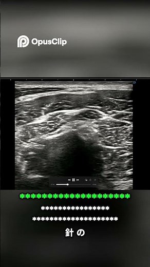 【整形外科医が解説】頸椎椎間関節注射の正確な手技を公開！ #頸椎椎間関節注射 #エコーガイド下注射 #首の痛み#整形外科 #頚椎症 #肩こり #後頭部痛 #超音波ガイド #医師解説#頸部痛