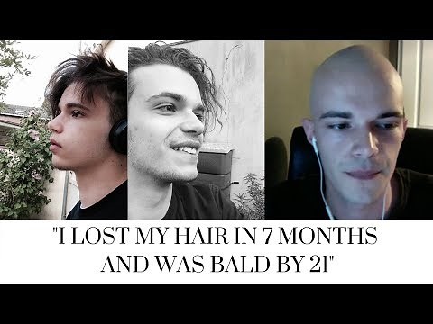 GOING BALD YOUNG *Bald at 21* The Bald Cafe Podcast Ep 6