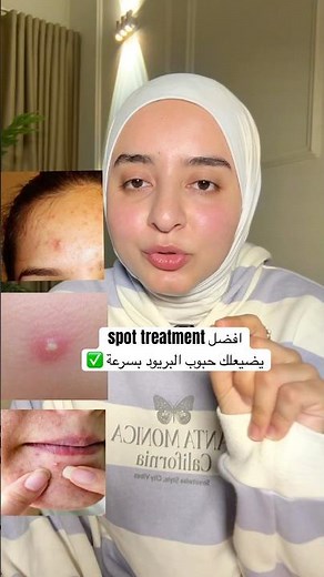 افضل spot treatment لحبوب البريود بسرعه من غير اثر ✅