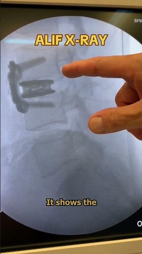 ALIF X-ray with Dr. Chappuis🩻