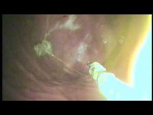 endoscopie digestive